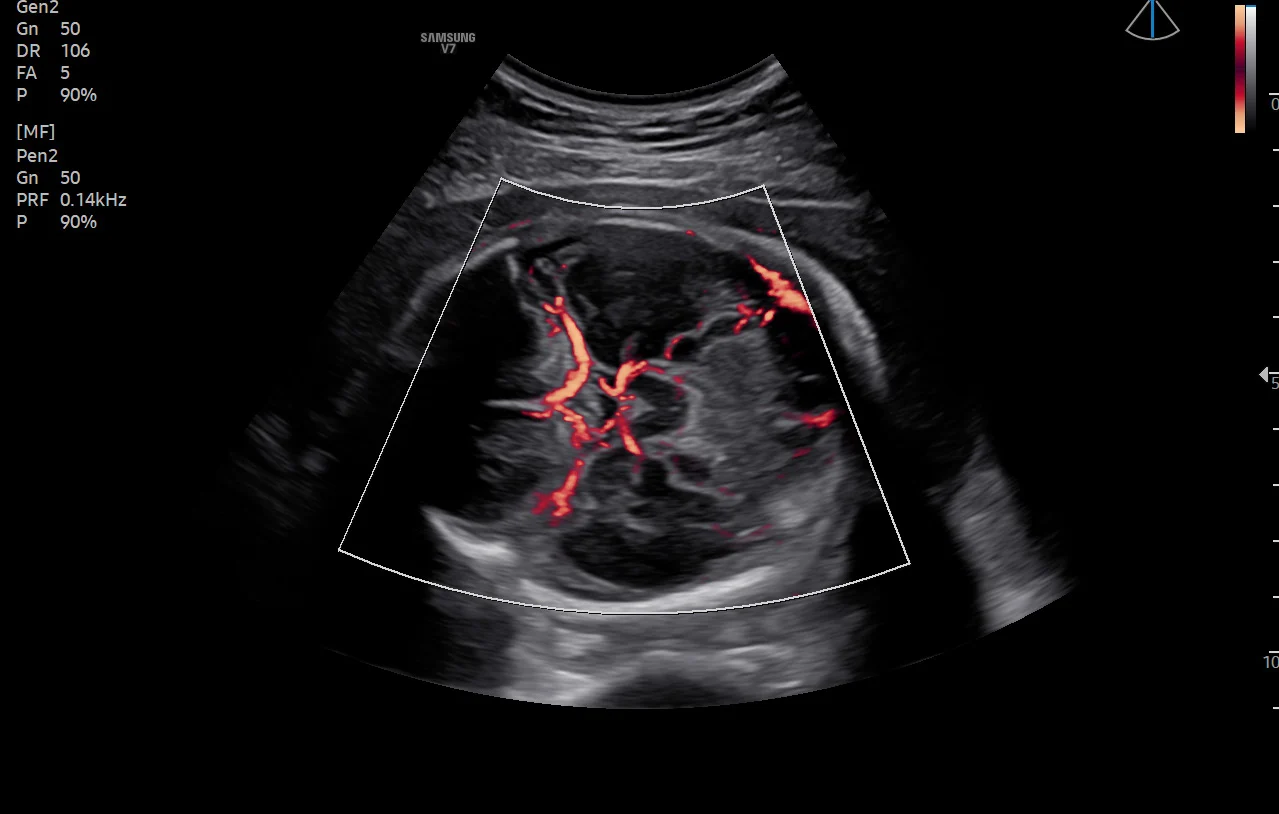 Cerebro fetal con MV-Flow
