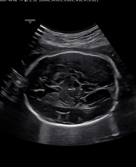 Cerebro fetal con ShadowHDR