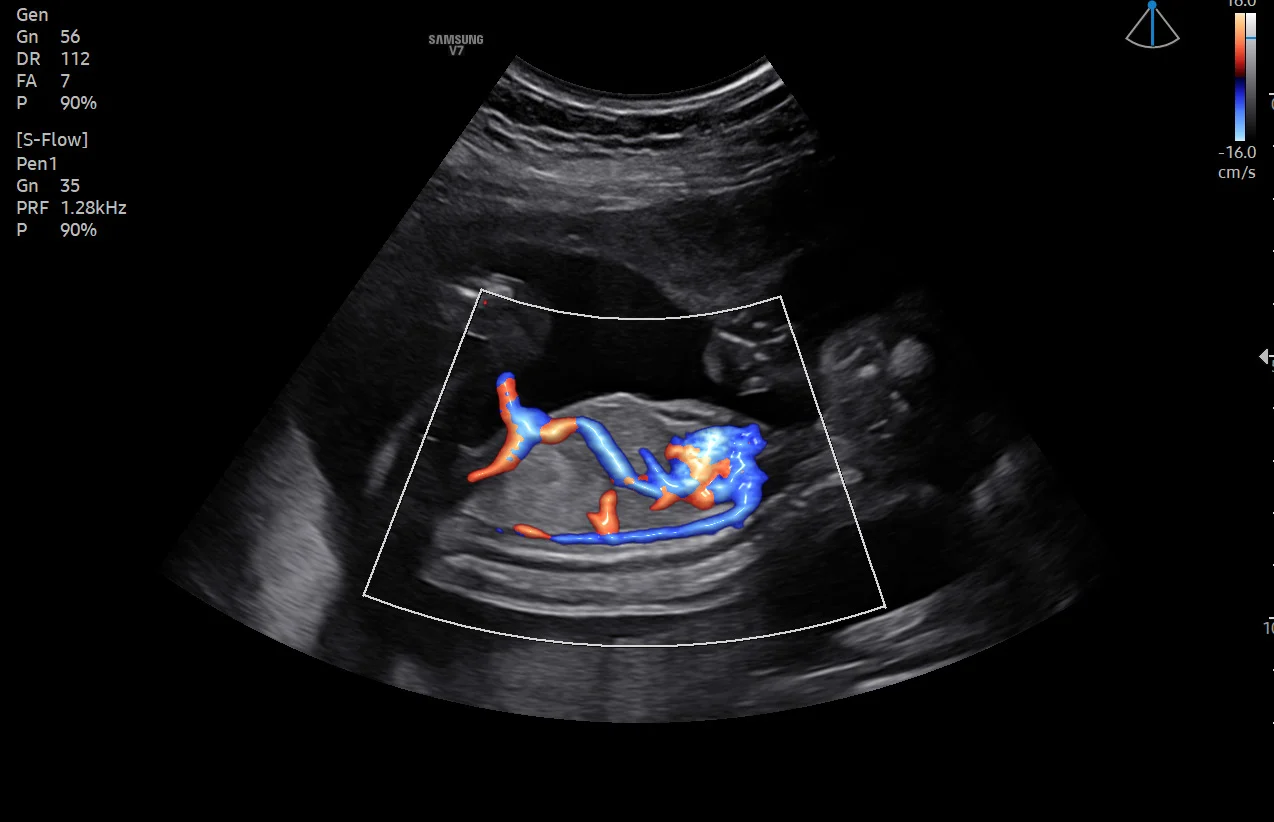 Circulación fetal con LumiFlow
