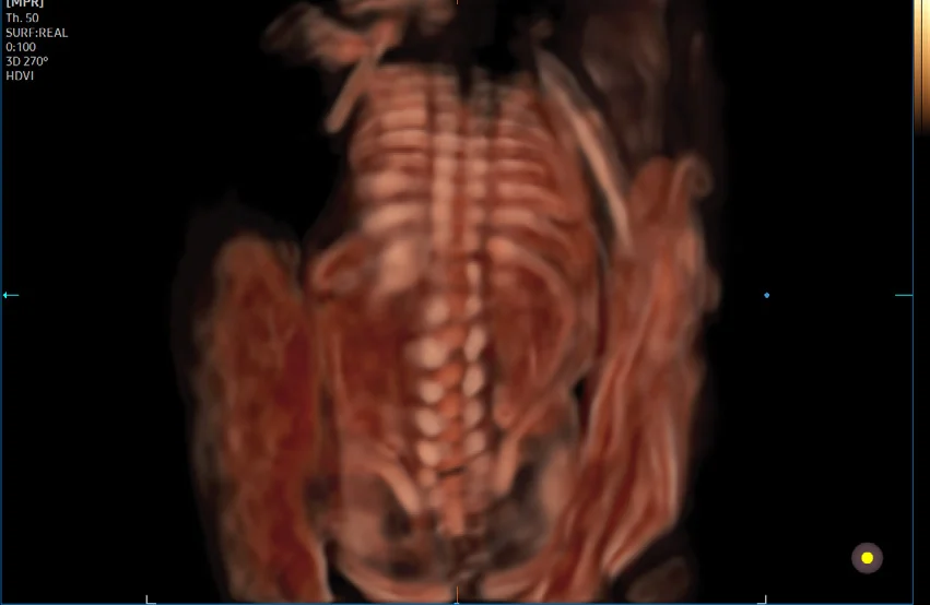 Columna fetal con CrystalVue