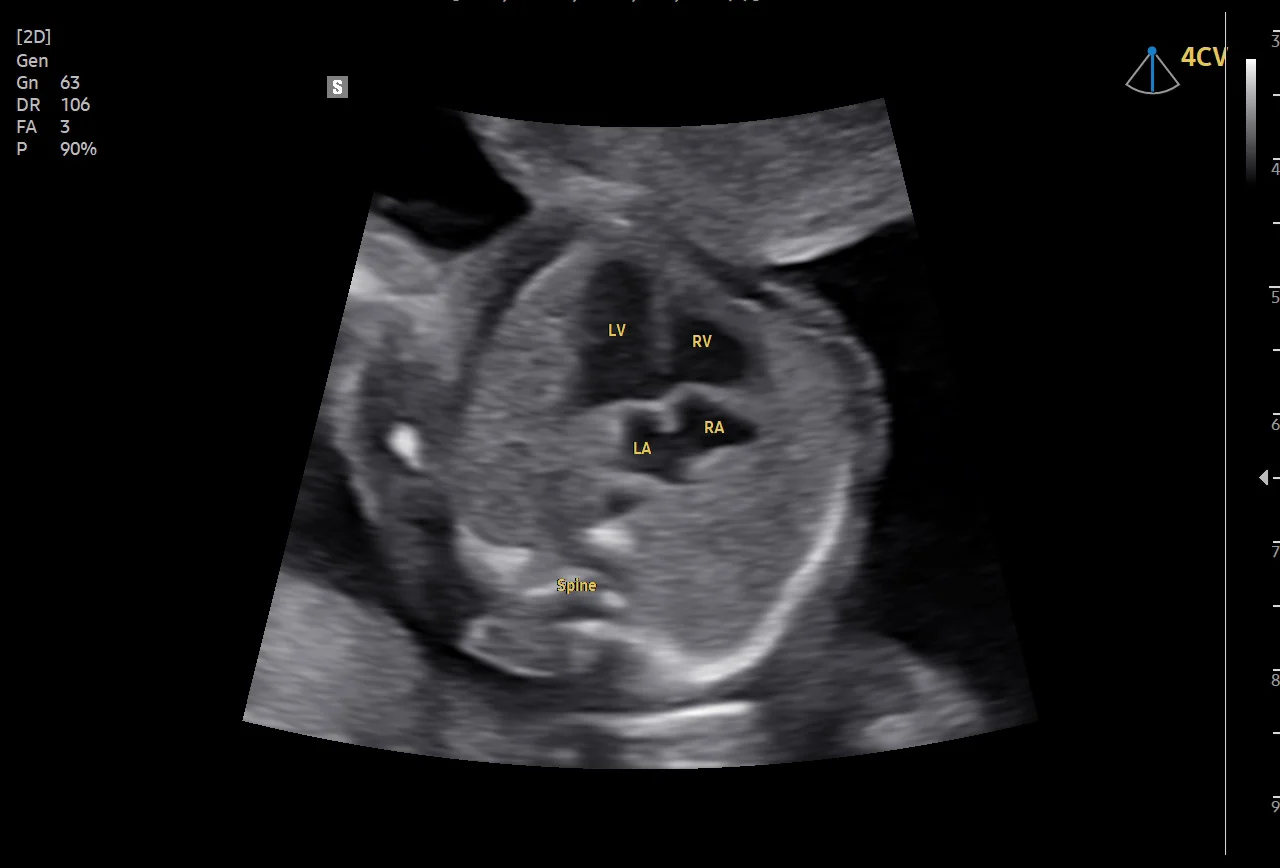 Corazón fetal, cuatro cámaras, con ViewAssist