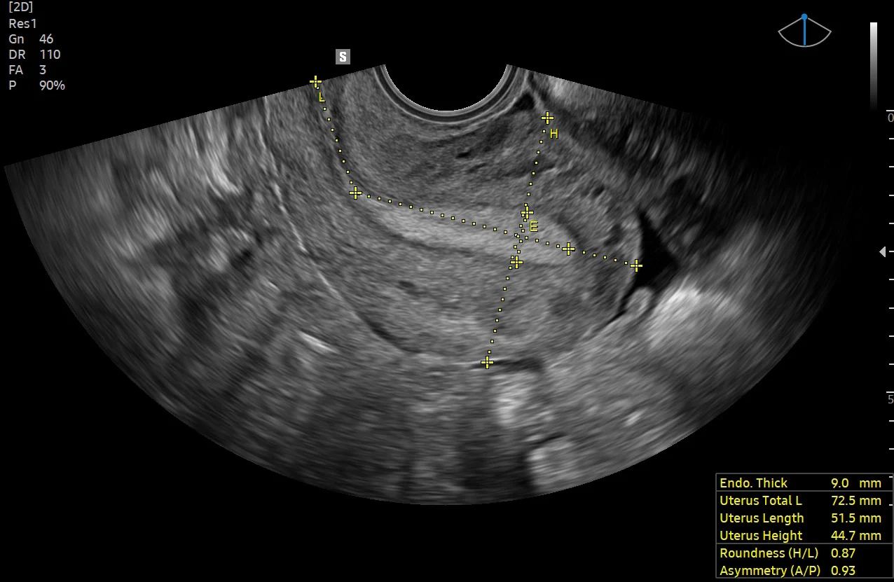 Útero con UterineAssist