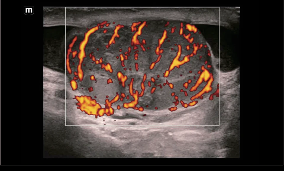 Power flow testicular