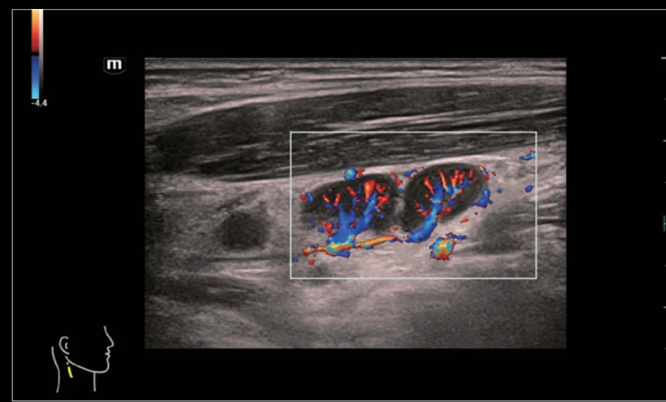 Ganglio cervical — Glazing Flow