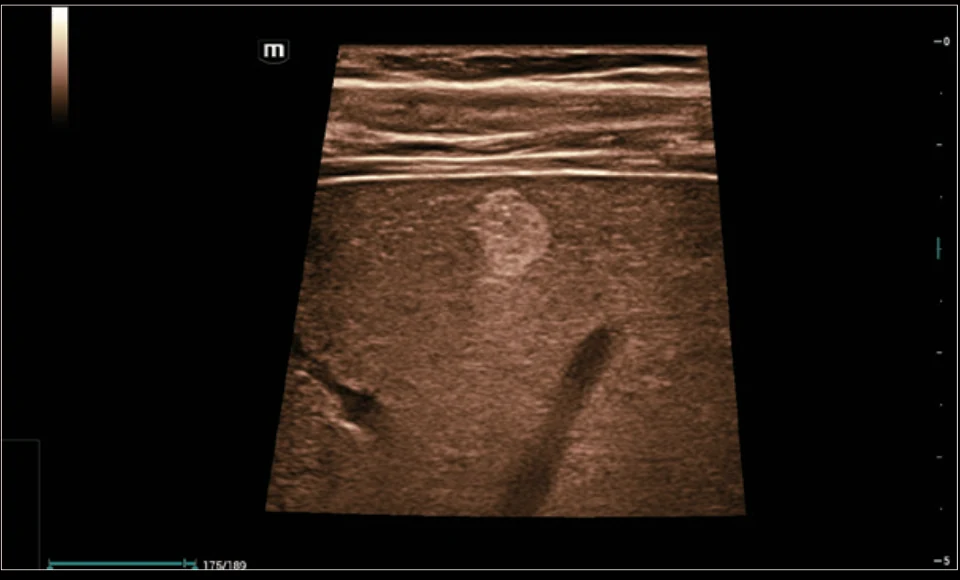 Hemangioma hepático