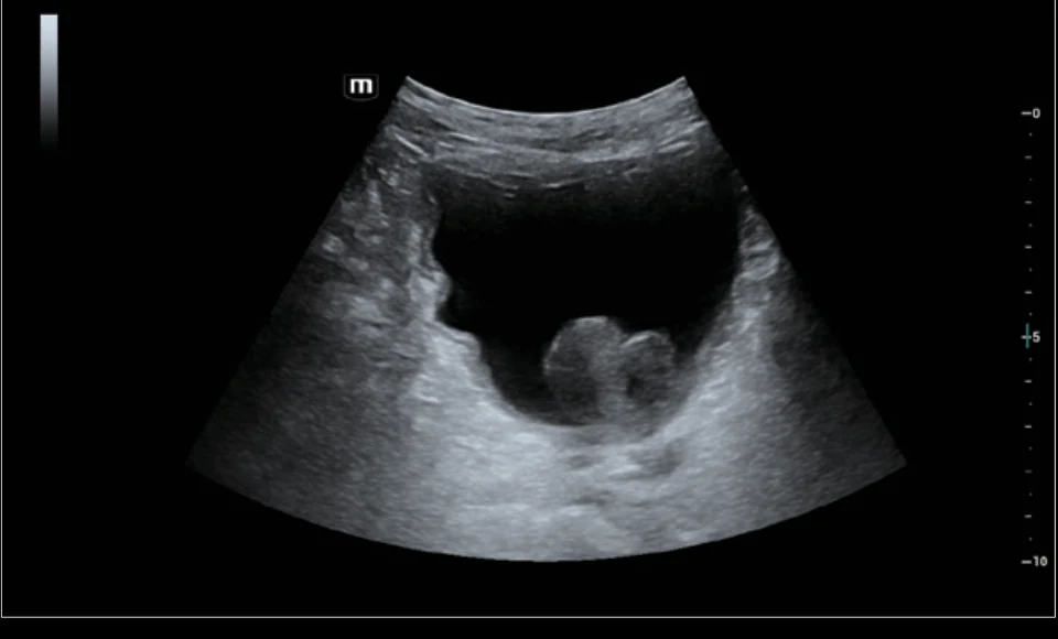 Tumor vesical